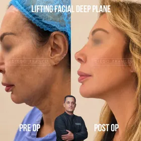 Deep plane facelift before and after result