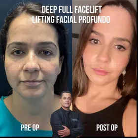Facelift before and after result
