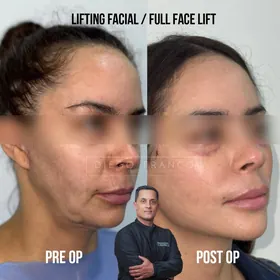 Full facelift before and after result