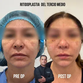 Midface lift before and after result