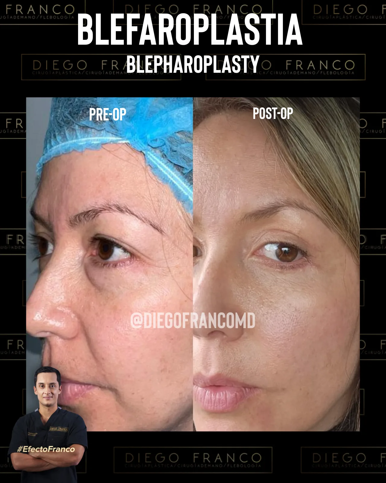 Eyelid surgery (blepharoplasty)