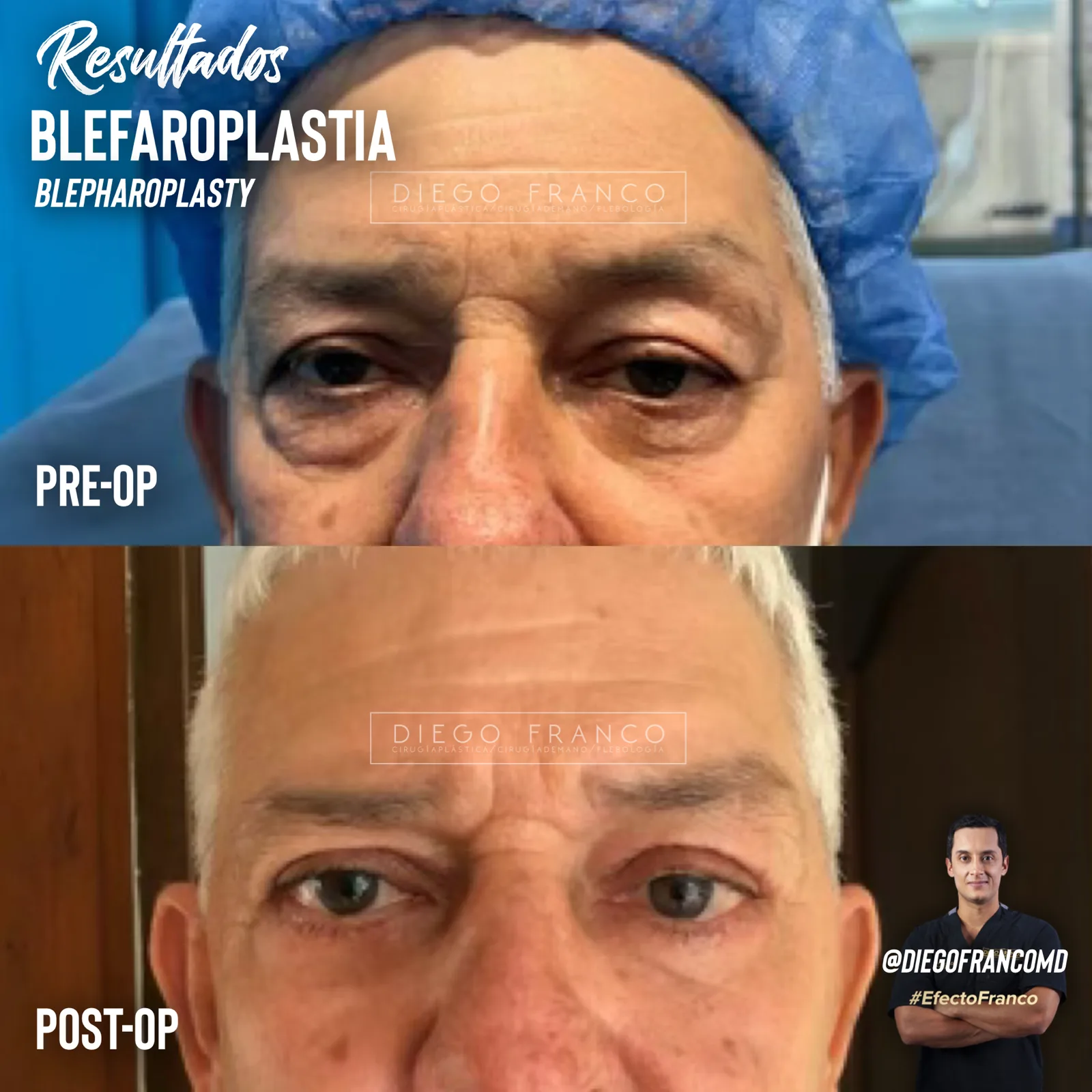 Eyelid surgery (blepharoplasty)