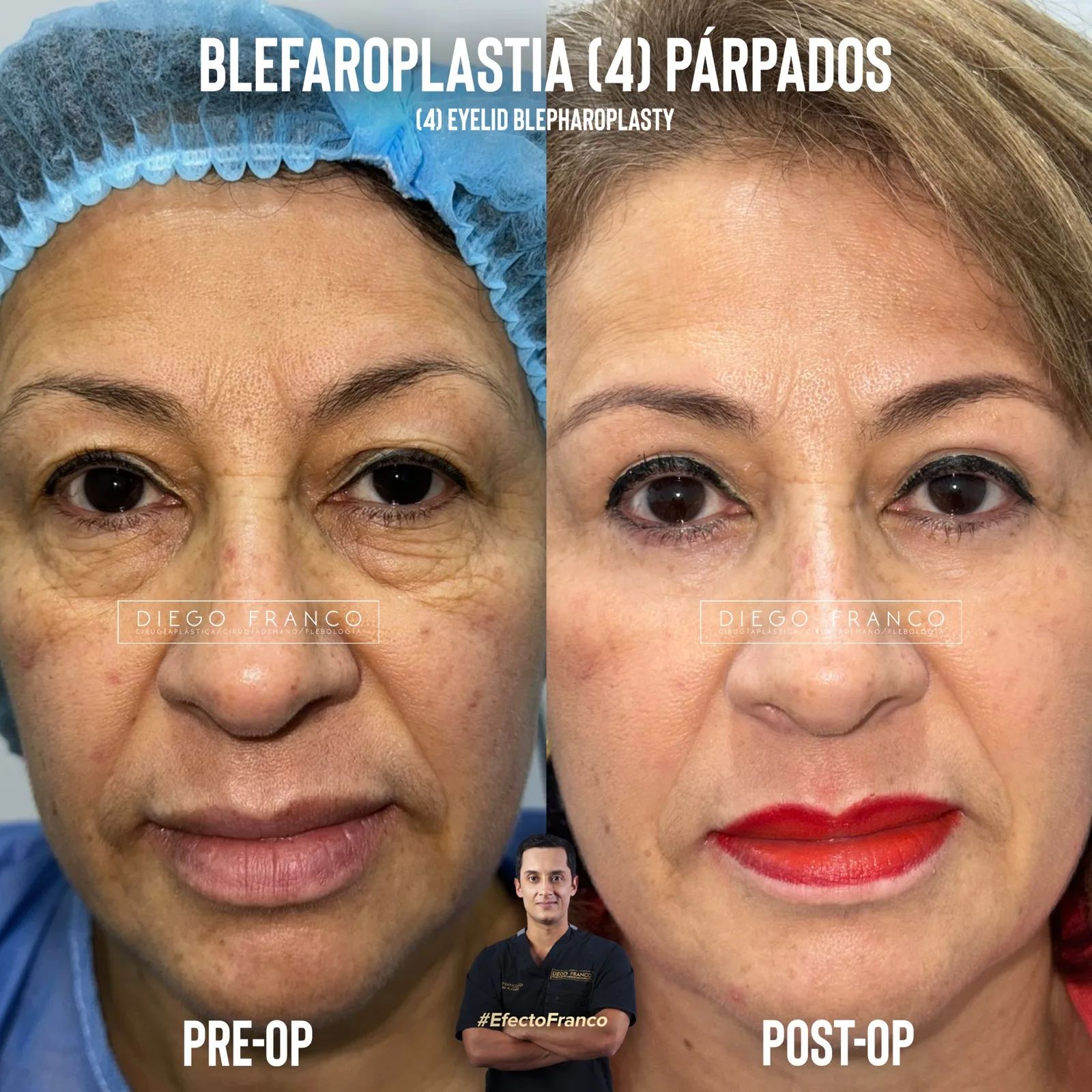 Eyelid surgery — four lids