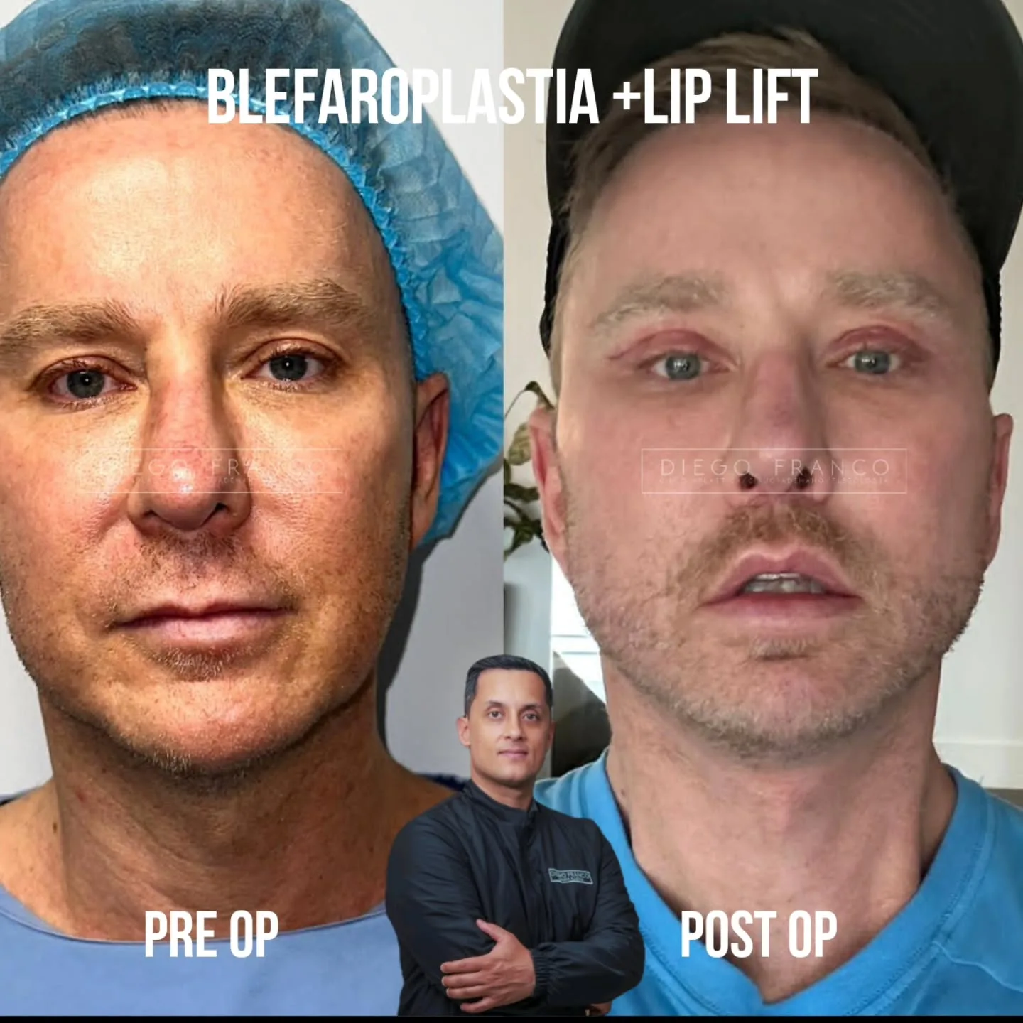 Blepharoplasty with lip lift
