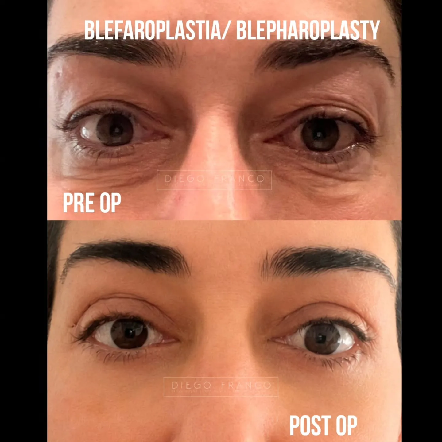 Eyelid surgery (blepharoplasty)