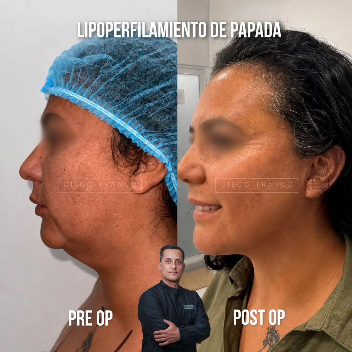 Facelift with chin liposuction