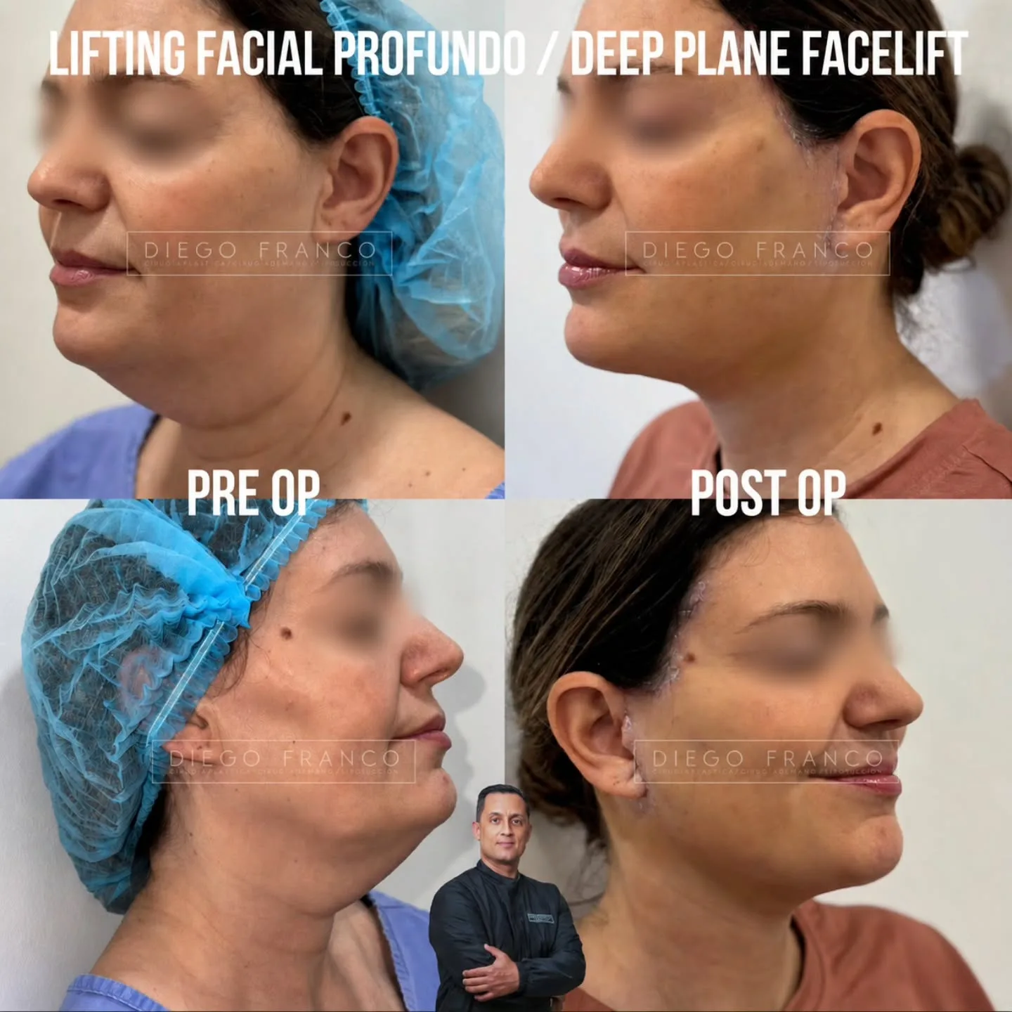 Deep plane facelift