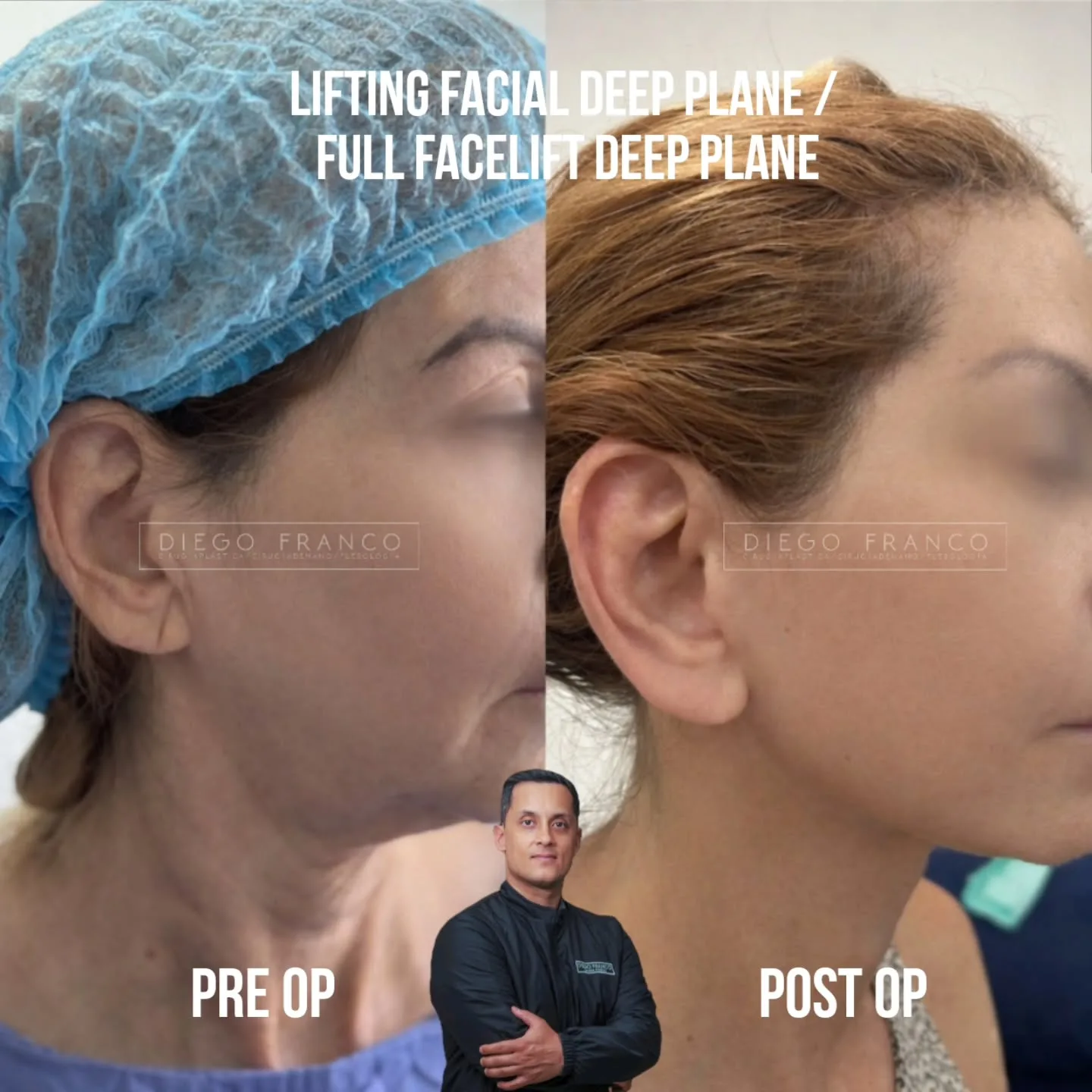 Deep plane facelift