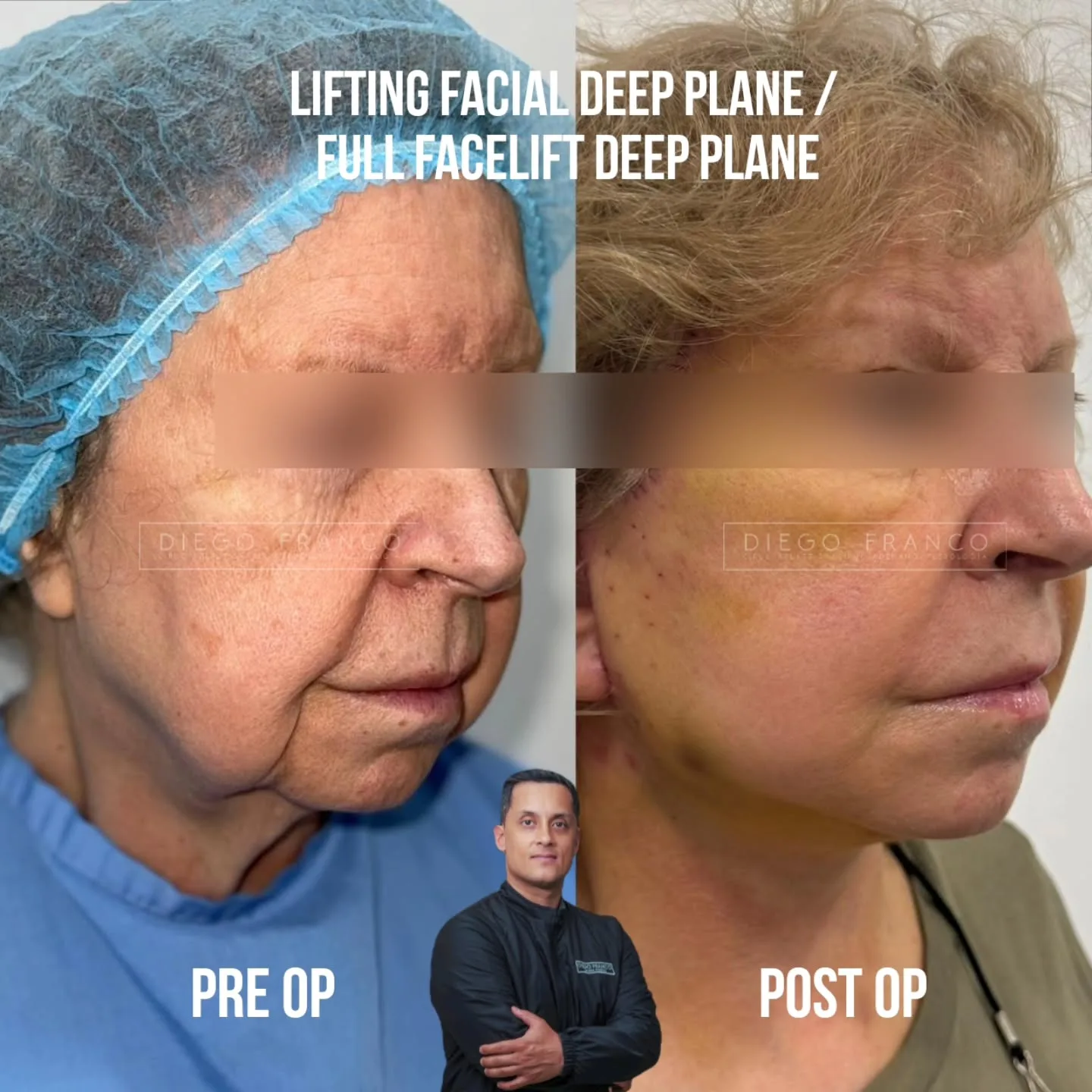 Deep plane facelift