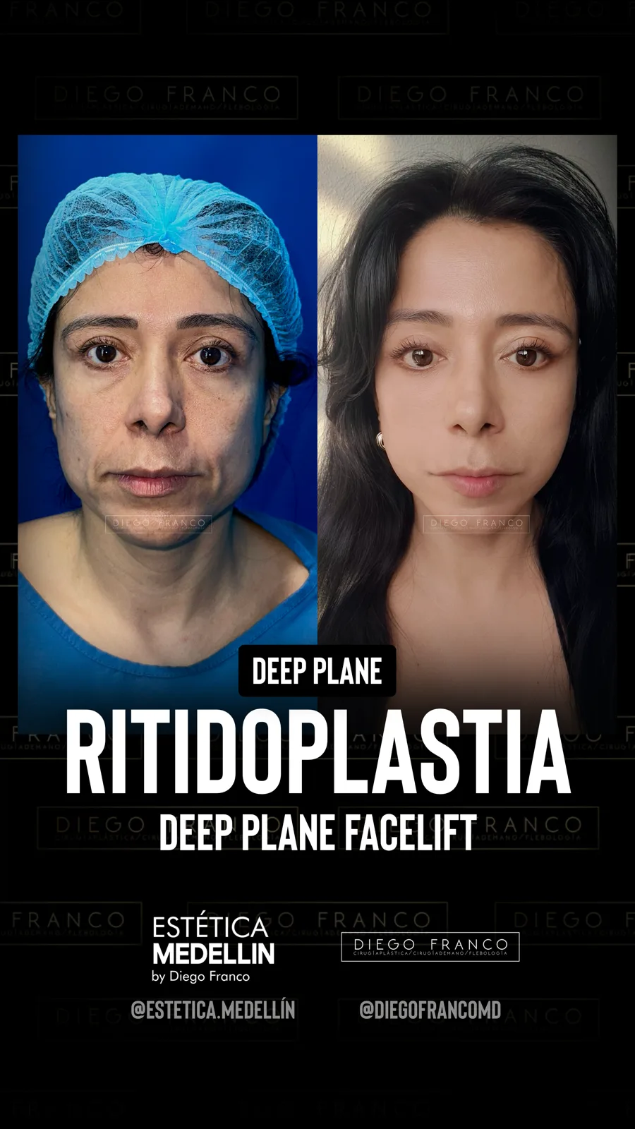 Deep plane facelift