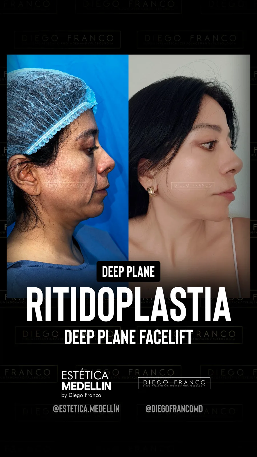 Deep plane facelift