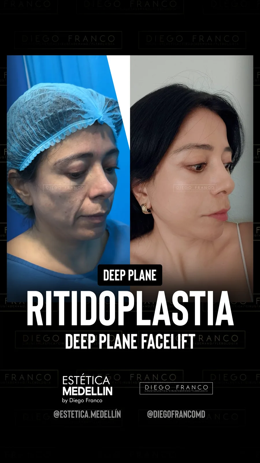 Deep plane facelift
