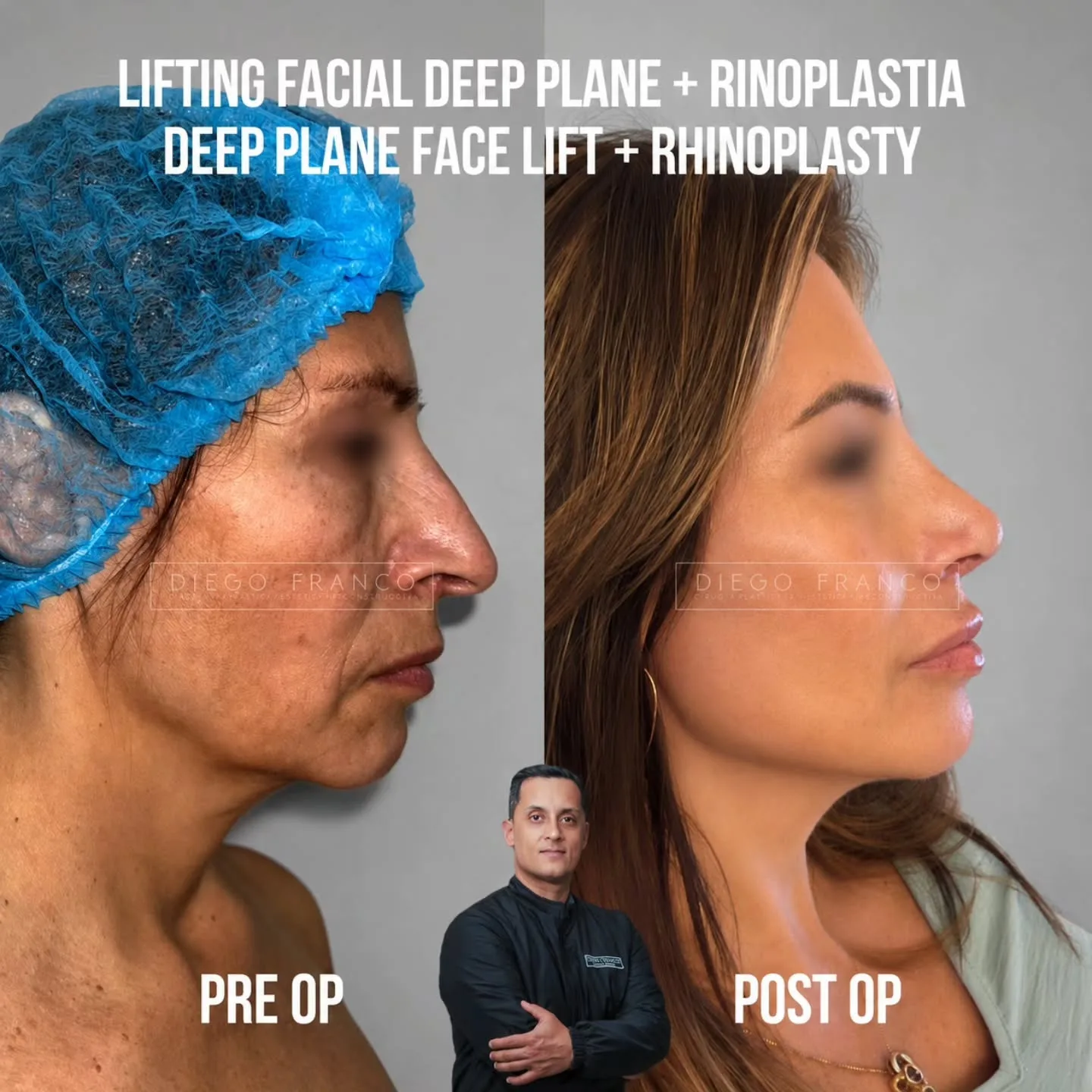Deep plane facelift