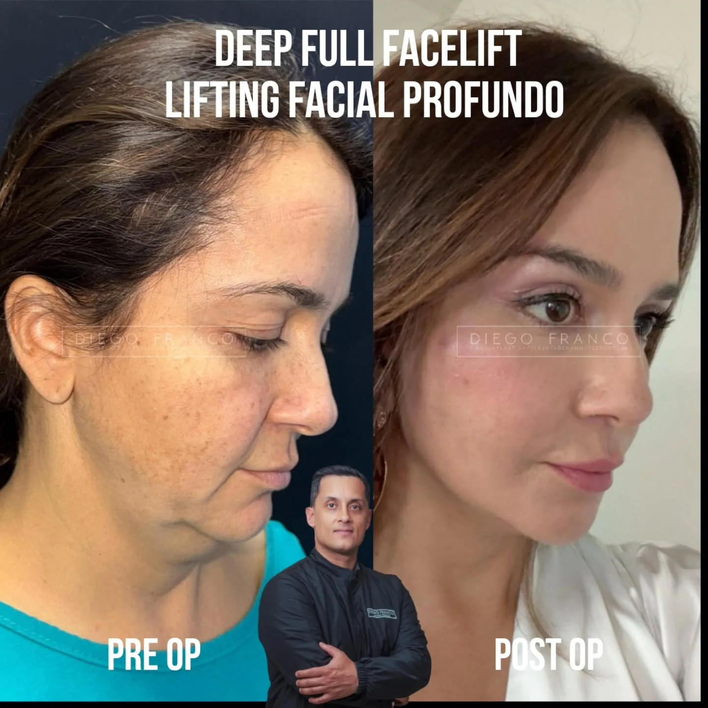 Full deep plane facelift