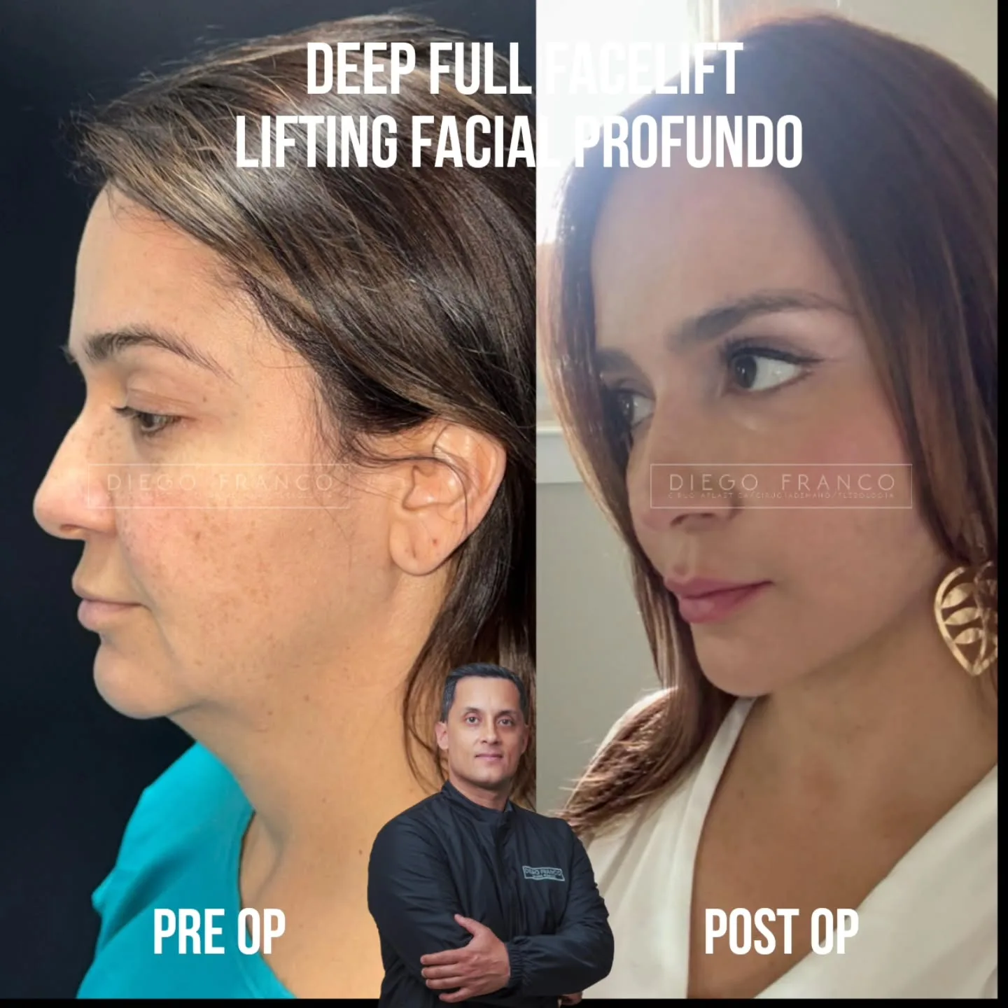 Full deep plane facelift