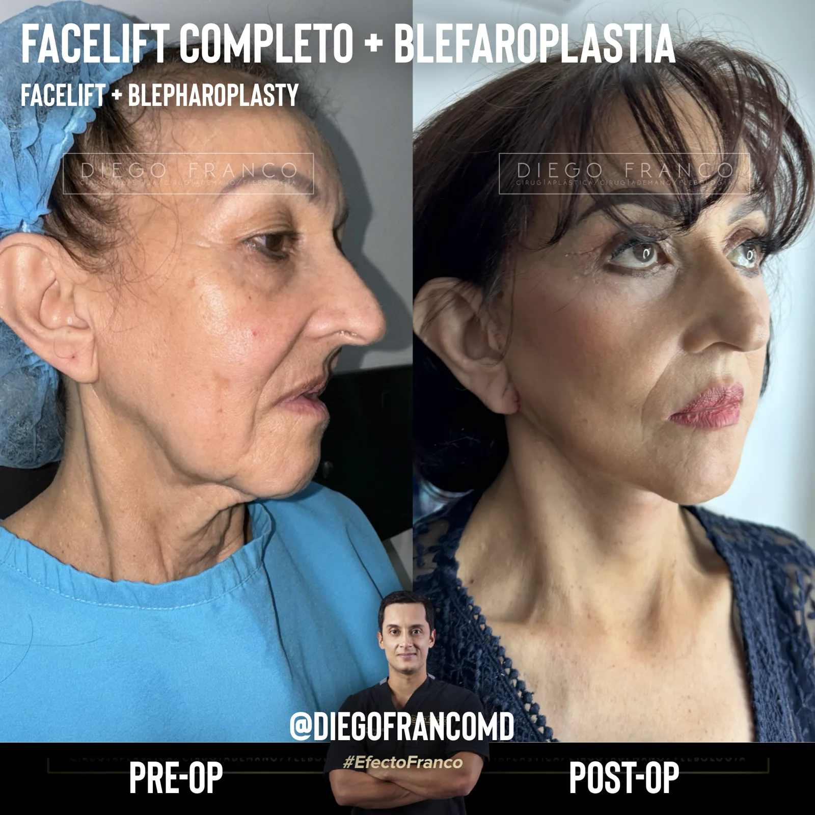 Facelift with eyelid surgery