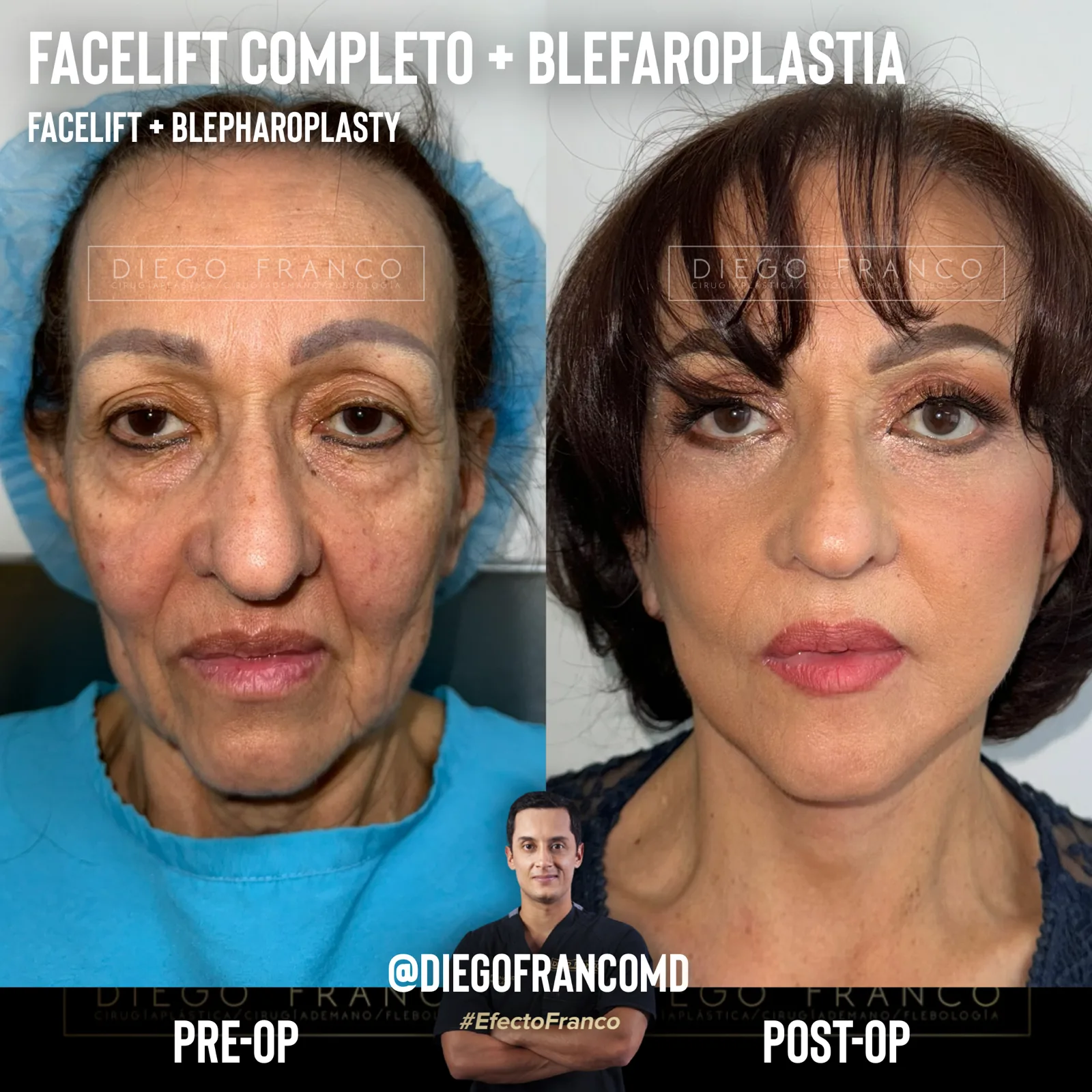 Facelift with eyelid surgery