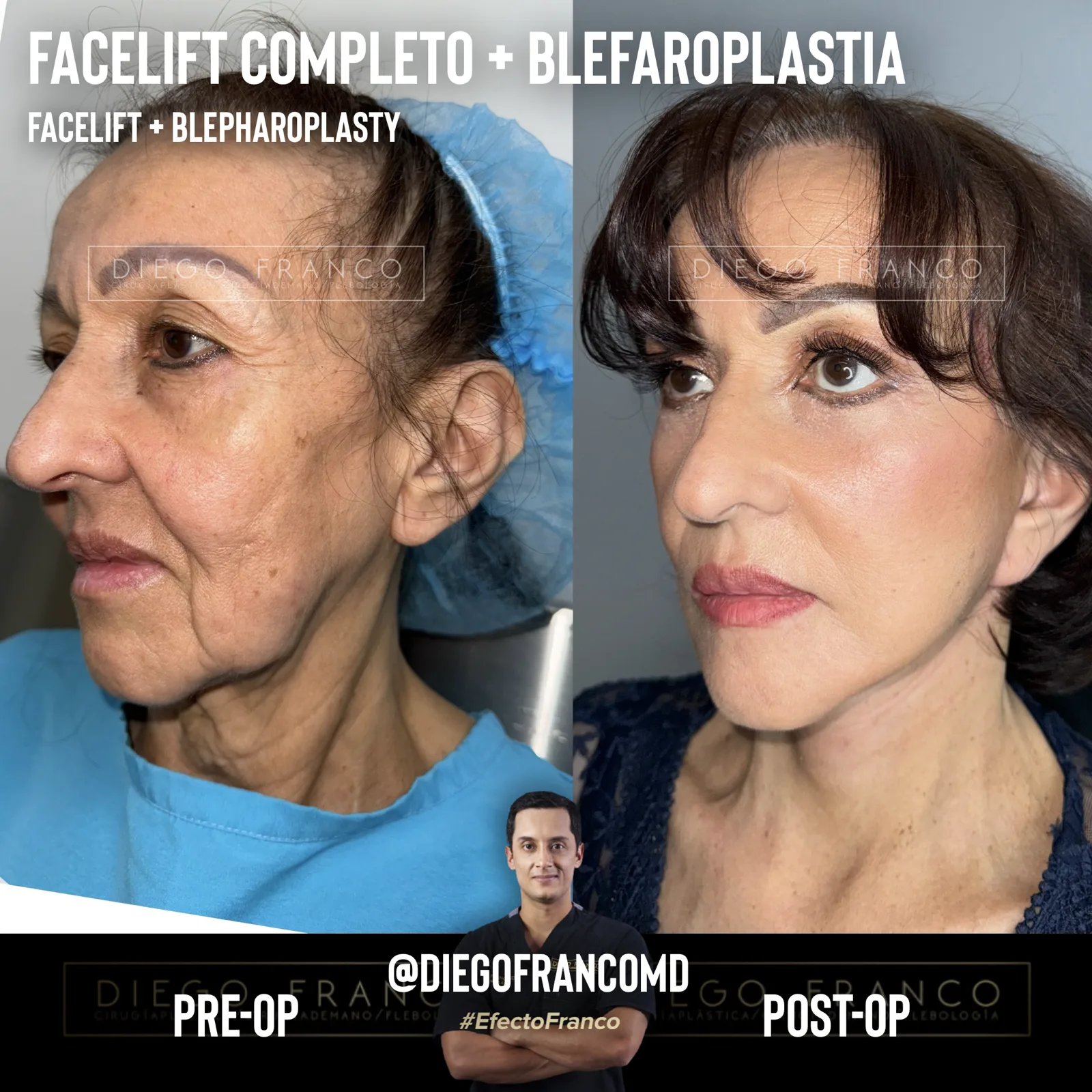 Facelift with eyelid surgery