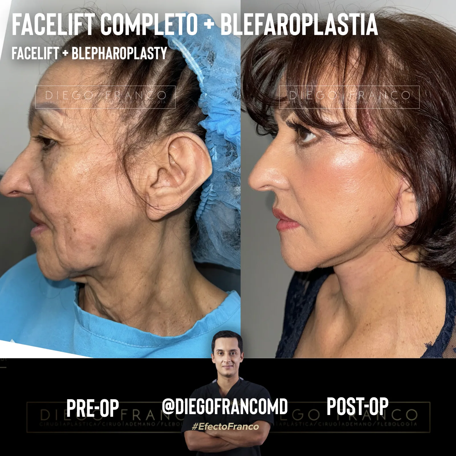 Facelift with eyelid surgery