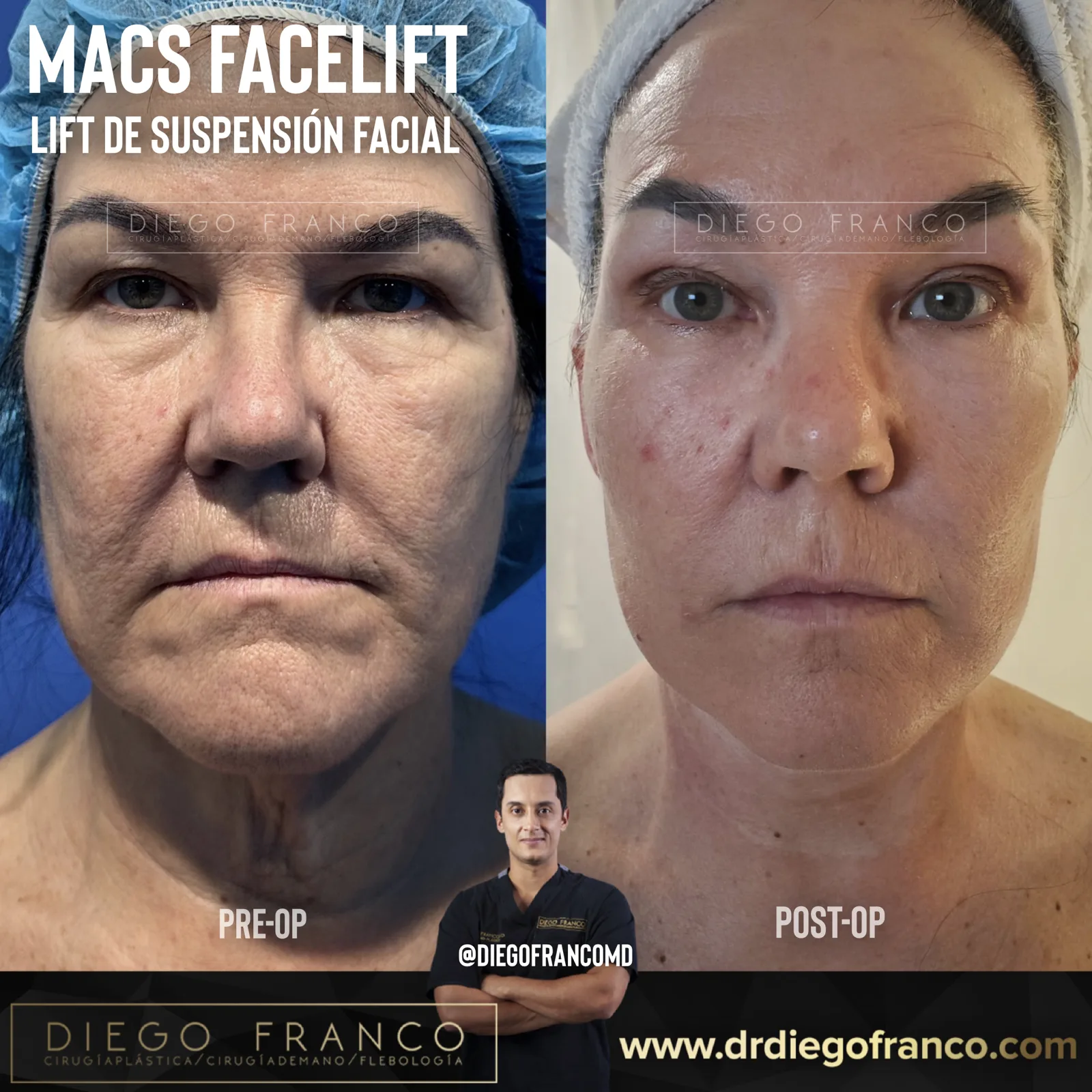 MACS mini facelift