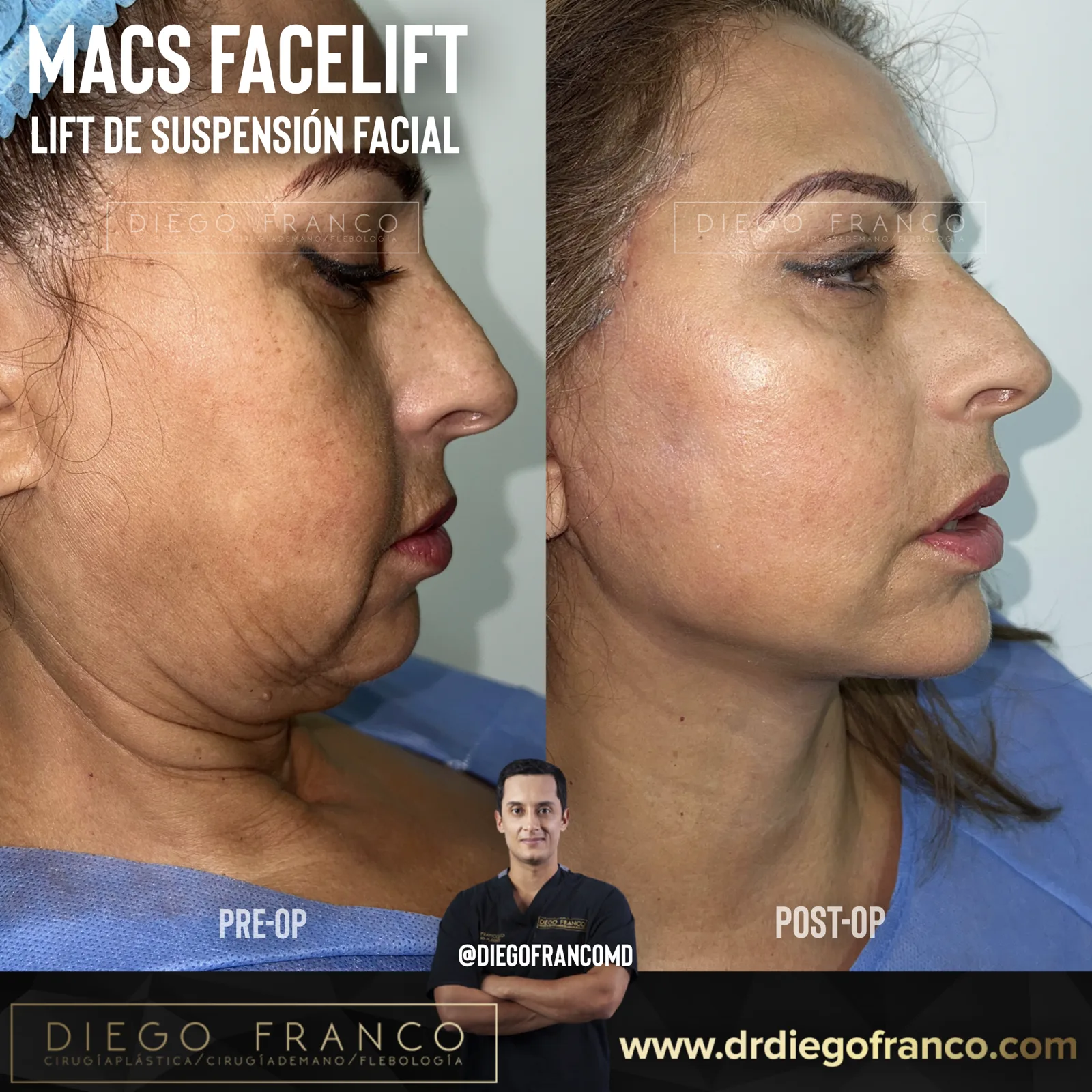 MACS mini facelift