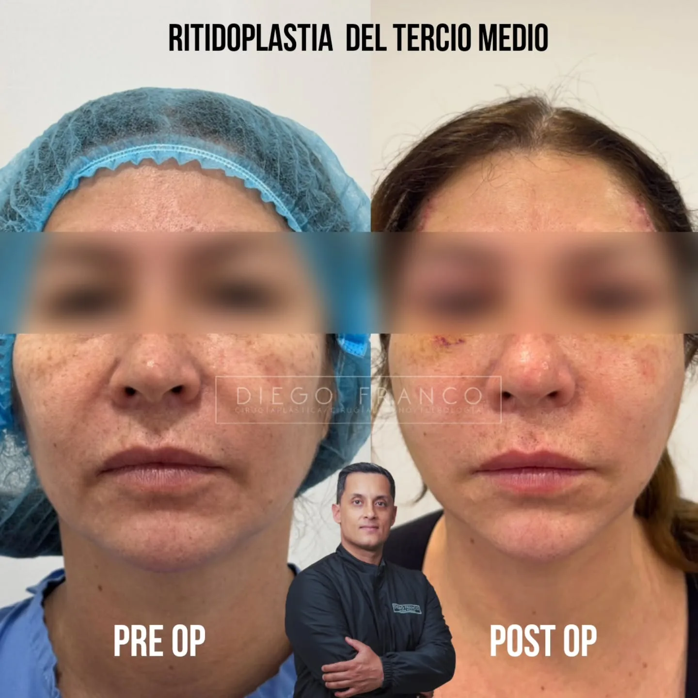 Midface lift