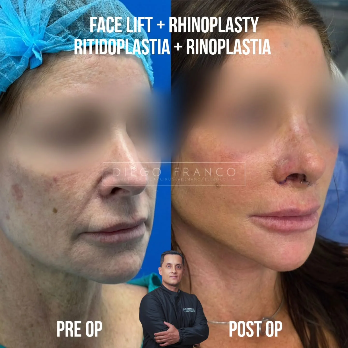 Facelift