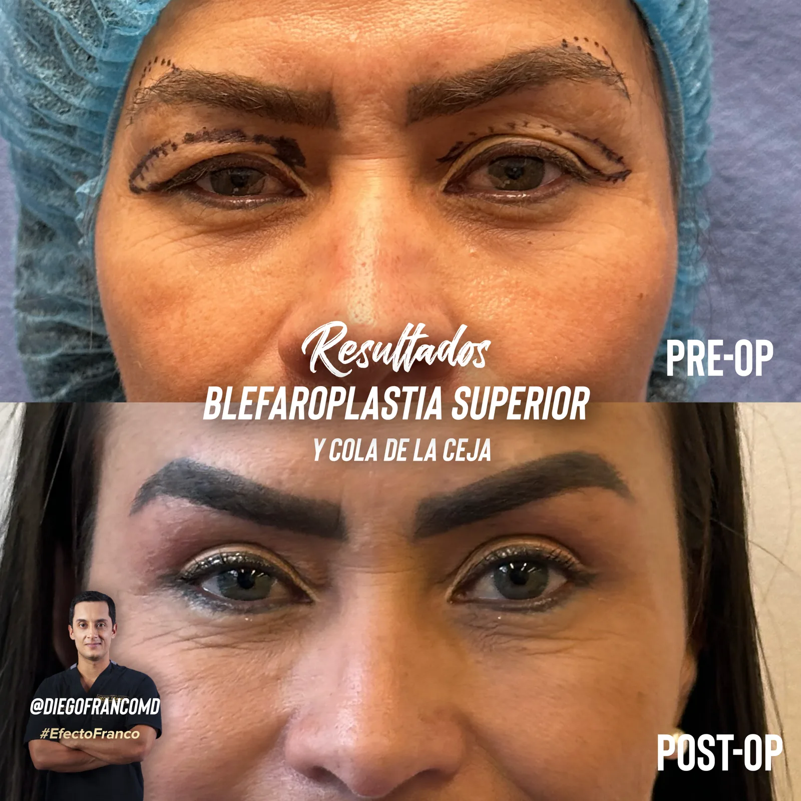 Upper blepharoplasty with brow lift