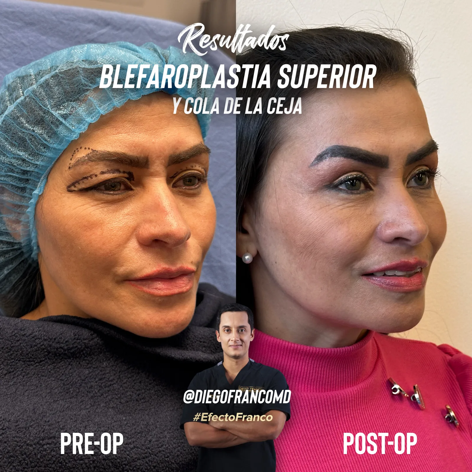 Upper blepharoplasty with brow lift
