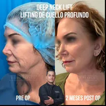 Neck lift before and after result