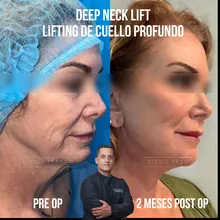 Neck lift before and after result